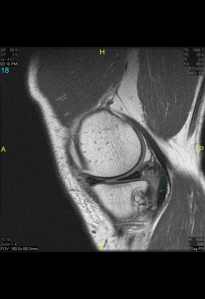 Figure 6 for case gout arthritis ( RID3567 )